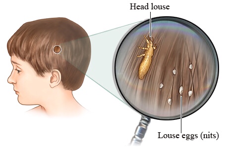 Head Lice Battle